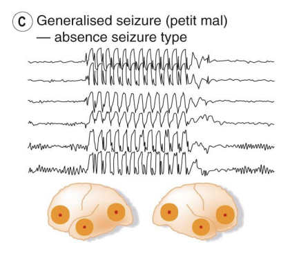 <p>Activity is altered across all brain regions, patient ceases physically activity, e.g. halts mid-sentence when speaking, recovery occurs with no aftereffects. </p><p>The rhythmicity in EEG recording is likely due to oscillatory feedback between cortex and thalamus, which is dependent upon T-type CaVs.</p>