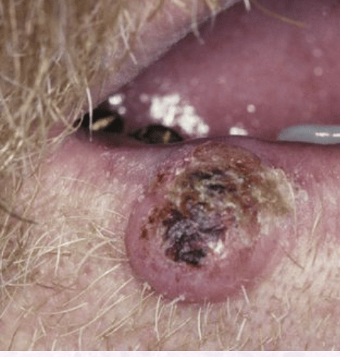<p>ASYMPTOMATIC</p><p>CENTAL KERATIN PLUG</p><p>Verruciform, irregular surface</p><p>Can be black, brown, yellow, red</p><p>Firm, well demarcated</p><p>Sessile, dome shaped</p>