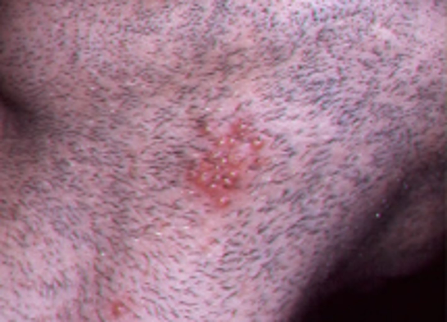 <p>herpes barbae</p>