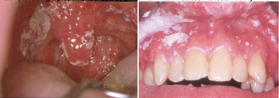 <p>Name the oral candidiasis</p>