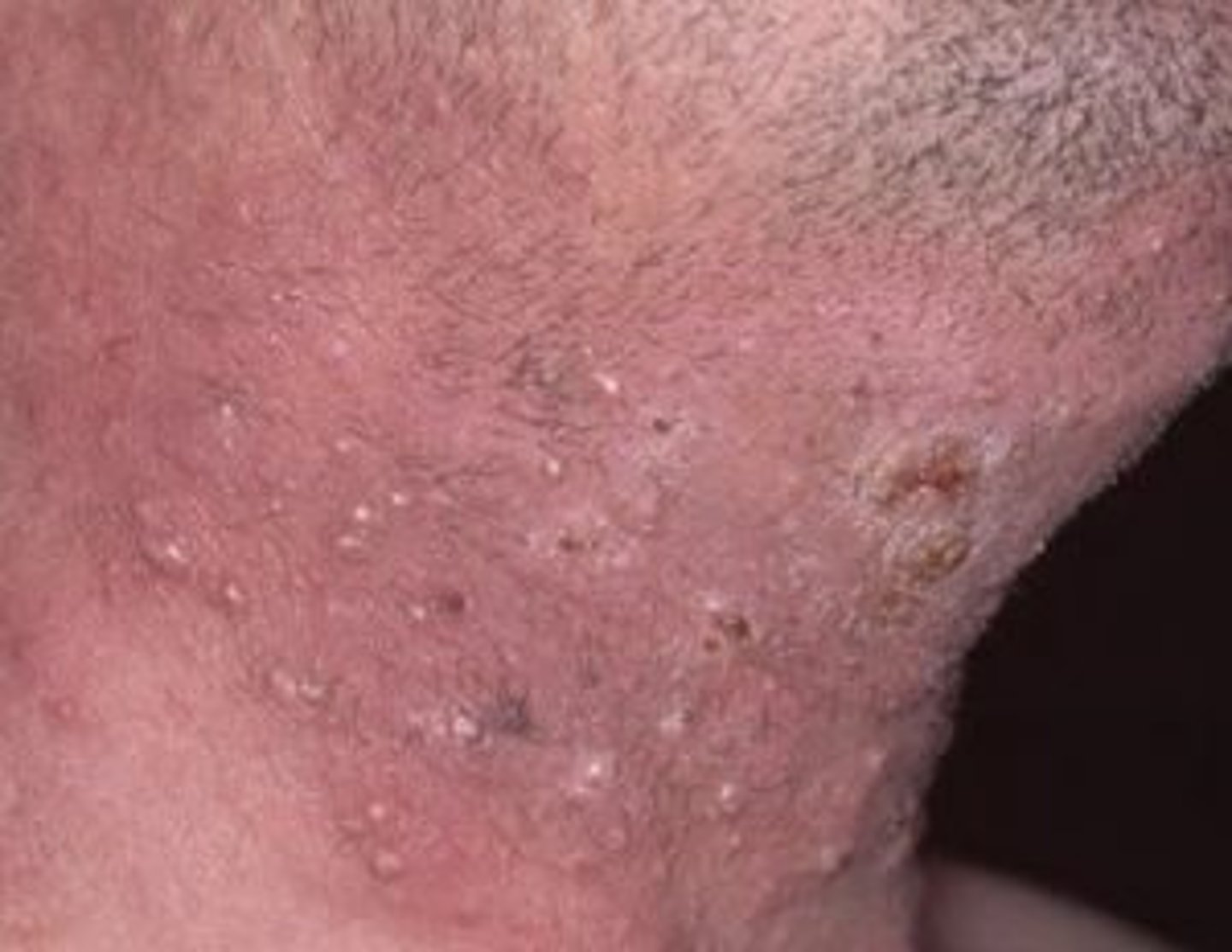<p>Folliculitis barbae</p>