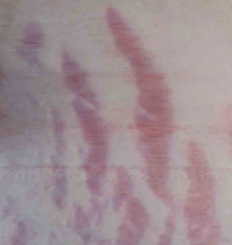 <p>what type of lesion is depicted and what condition is it</p>