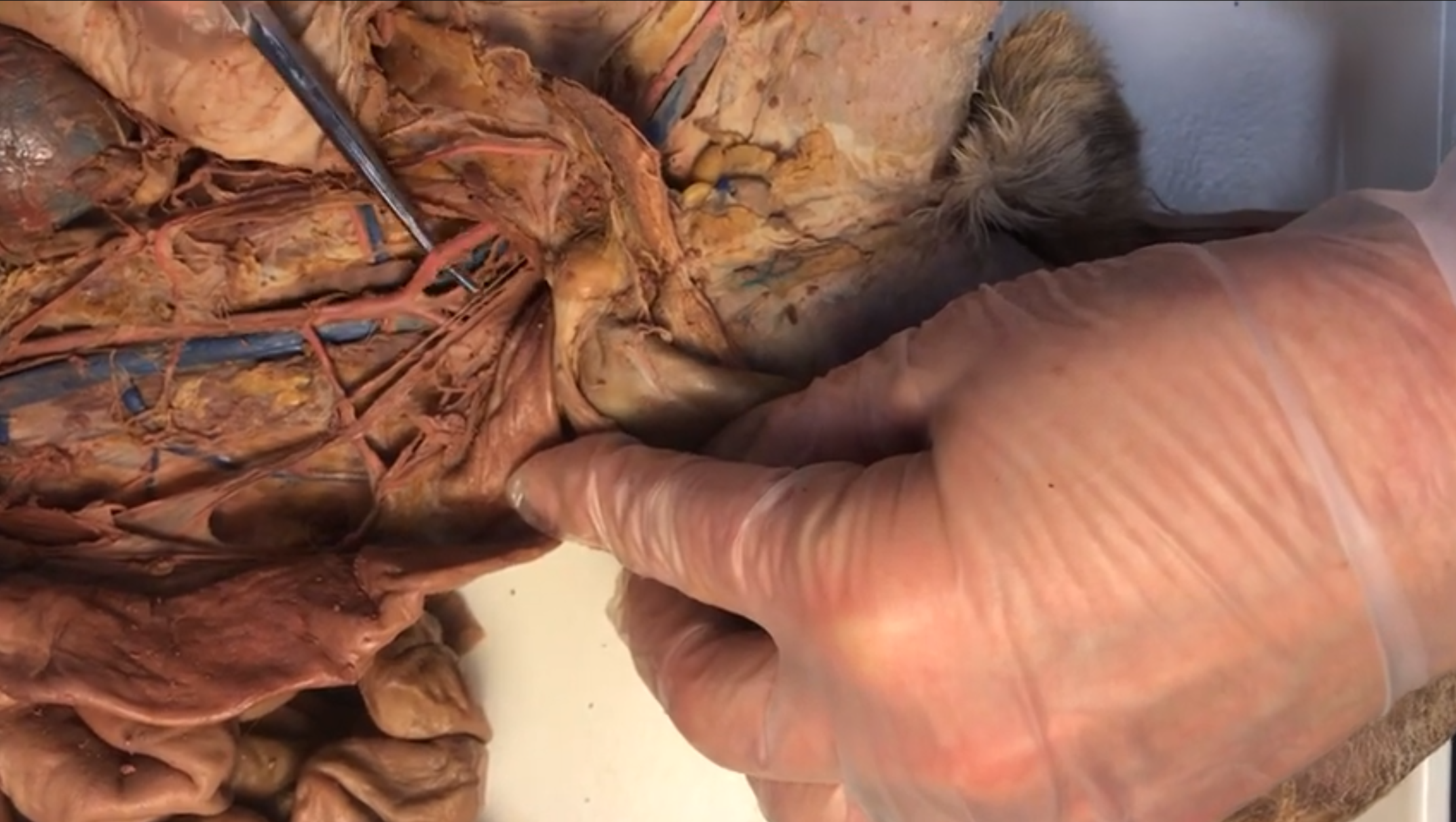 <p>What artery is this</p>