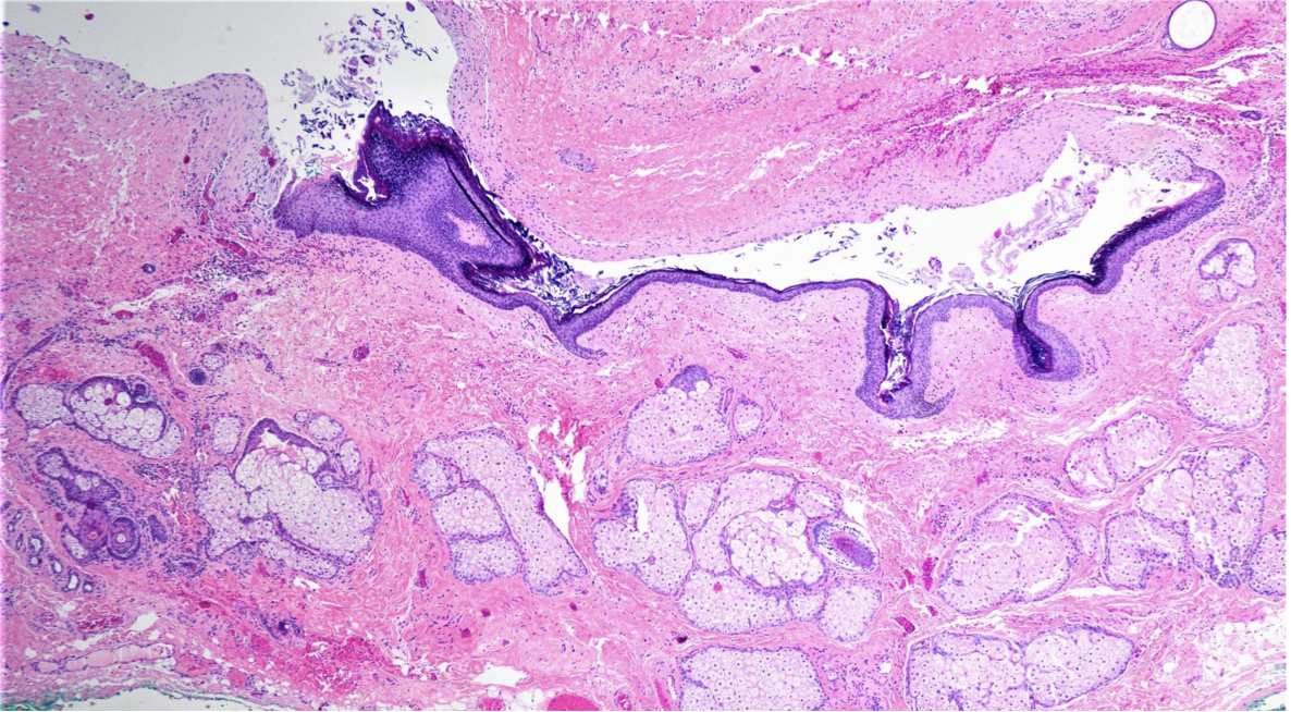 <p>A 35 year presented with cystic swelling on lateral part of forehead of 2 cm diameter. The microscopic image is shown below.</p>