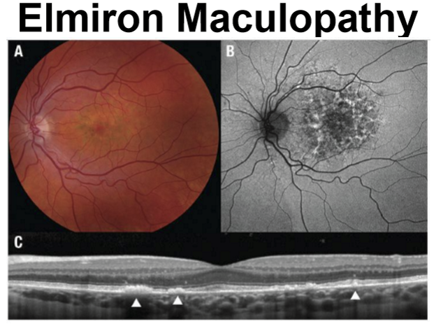 <ul><li><p>Tx of interstitial cystitis of the bladder (mostly Females) </p></li><li><p>Induces bilateral symmetrical paracentral hyperpigmentation with pale yellow deposits </p></li><li><p>Often misdiagnosed as dry AMD (but lacks drusen) or pattern dystrophy of the RPE</p></li><li><p>Nodular thickening of the RPE on OCT </p></li></ul><p></p>