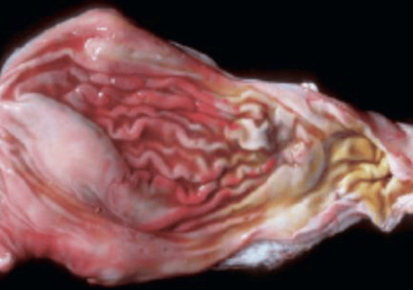 <p>What will you see in uremic gastritis?</p>