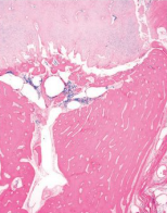 <p>Affects Dexters and other minatures</p><p>Caused by 2 different mutations in ACAN gene</p><p>Gross:</p><ul><li><p>aborted before 7th month of gestation. Small calves, short limbs, protruding mandible, domed head, cleft palate, normal size tongue protruding from mouth</p></li></ul><p>Histo:</p><ul><li><p>lacks distinct growth plates</p></li><li><p>densely packed chondrocytes in physeal cartilage with no orderly arrangement. Fibrillar eosinophilic intercellular matrix</p></li></ul><p></p>