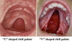 <p>U shaped cleft palate </p>