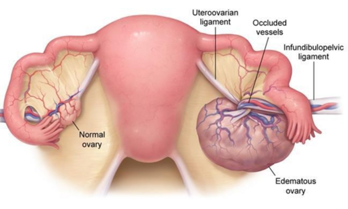 <p>A sausage-shaped, cystic structure separate from the ovary.</p>