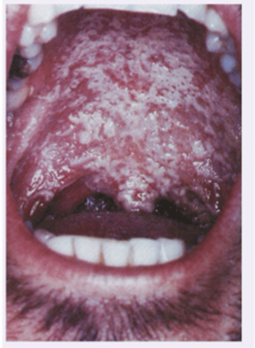 <p>This patient is immunocompromised and has been on antibiotics recently. He is on corticosteroids frequently. Diagnosis?</p>