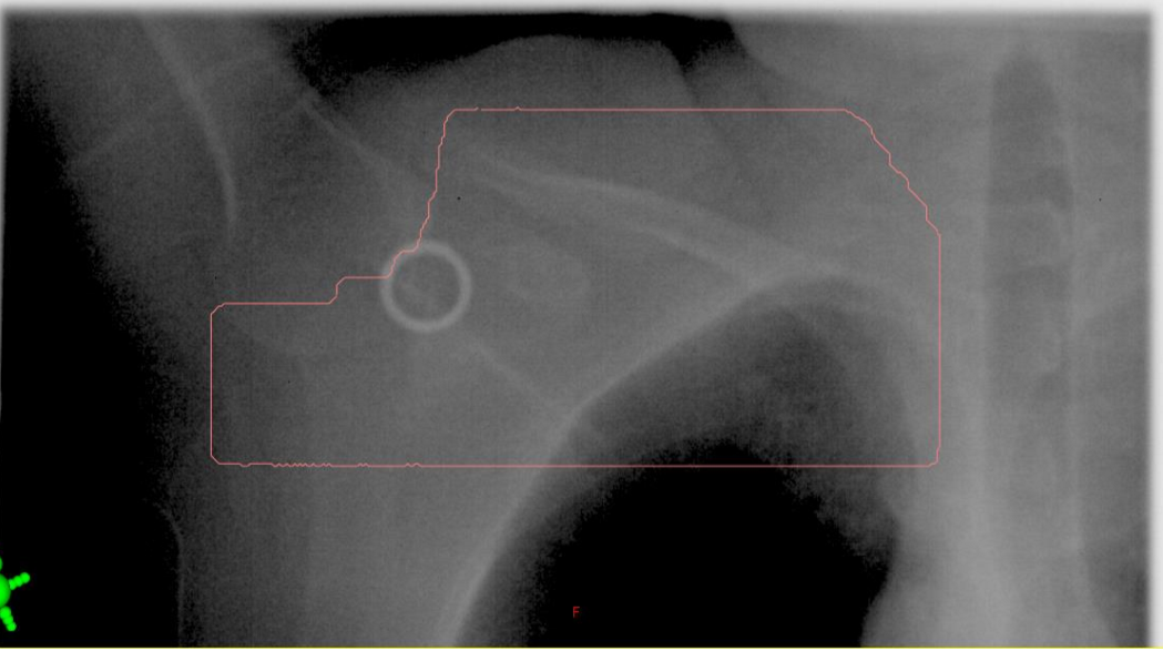 <p>when looking at a supraclav BEV, do we assess lung volume?</p>
