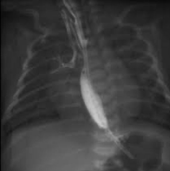 <p>Abnormal or surgically made passage between structures</p><p>Trachea/esophagus</p><p>Common congenital abnormality</p>
