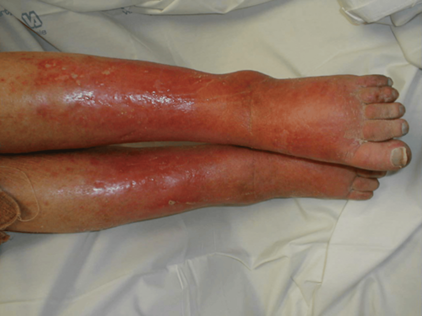 <p>bacterial infection of dermis and subcutaneous tissue</p><p>-red, hot, tender</p><p>-staph, strep, H. flu enters through break in skin</p><p>marked w/ pen to trace growth</p>