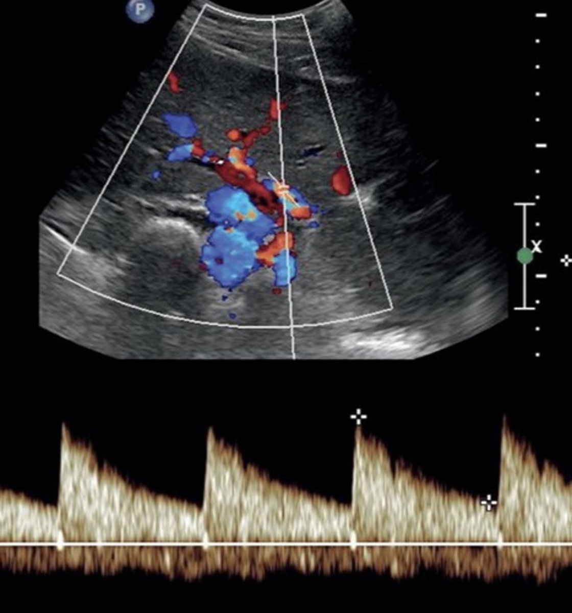 <p>Hepatopetal</p><p>Low resistant monophasic pan-diastolic forward flow</p>