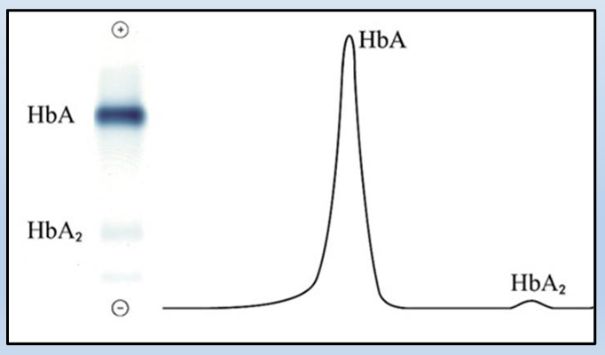 <p>The hemoglobin bands are visualized by the application of a dye, which also makes them measurable by densitometry. The patterns are scanned on a scanning densitometer, and the relative percent of each band is determined</p>