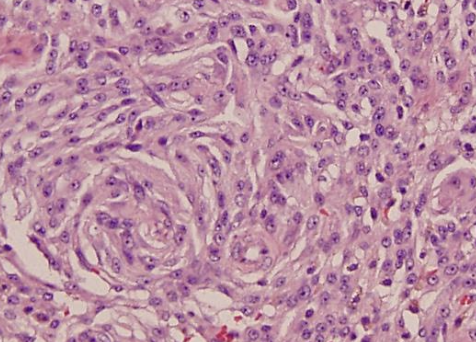 <p>heterogenous population of mesenchymal tumors</p>