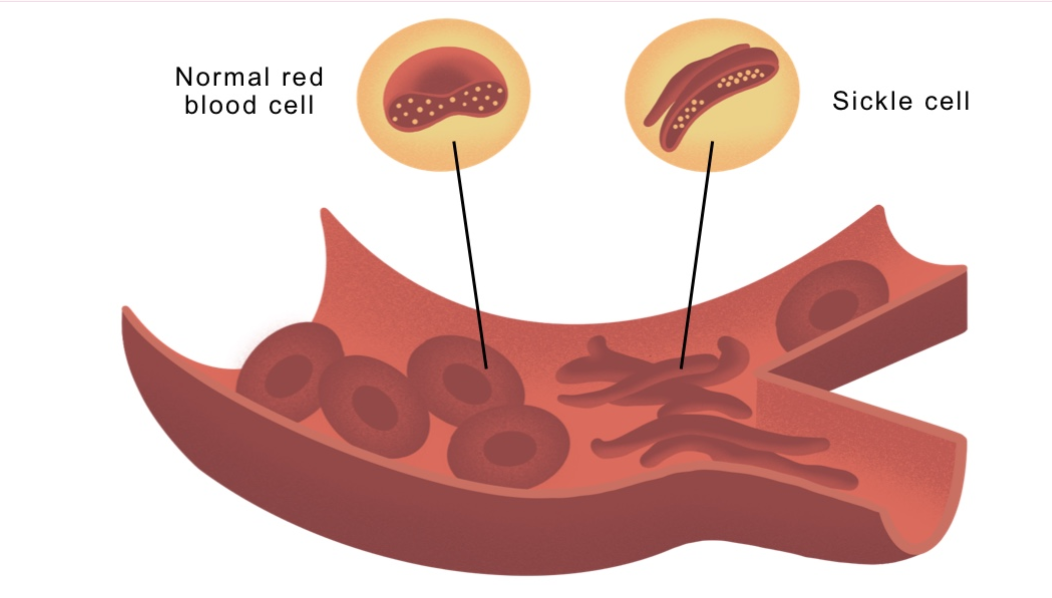 <p>sickel cell anemia</p>