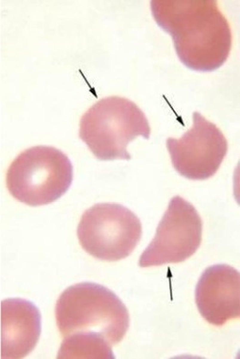 <p>- G6PD anemia</p>