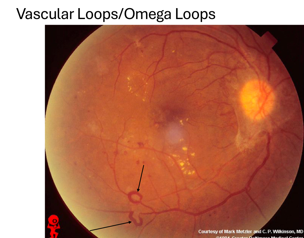 <p>extensive manipulation of vein/venule</p><ul><li><p>formed to bypass an occlusive area in vein/venule</p></li><li><p>appears as loop</p></li></ul><p></p>