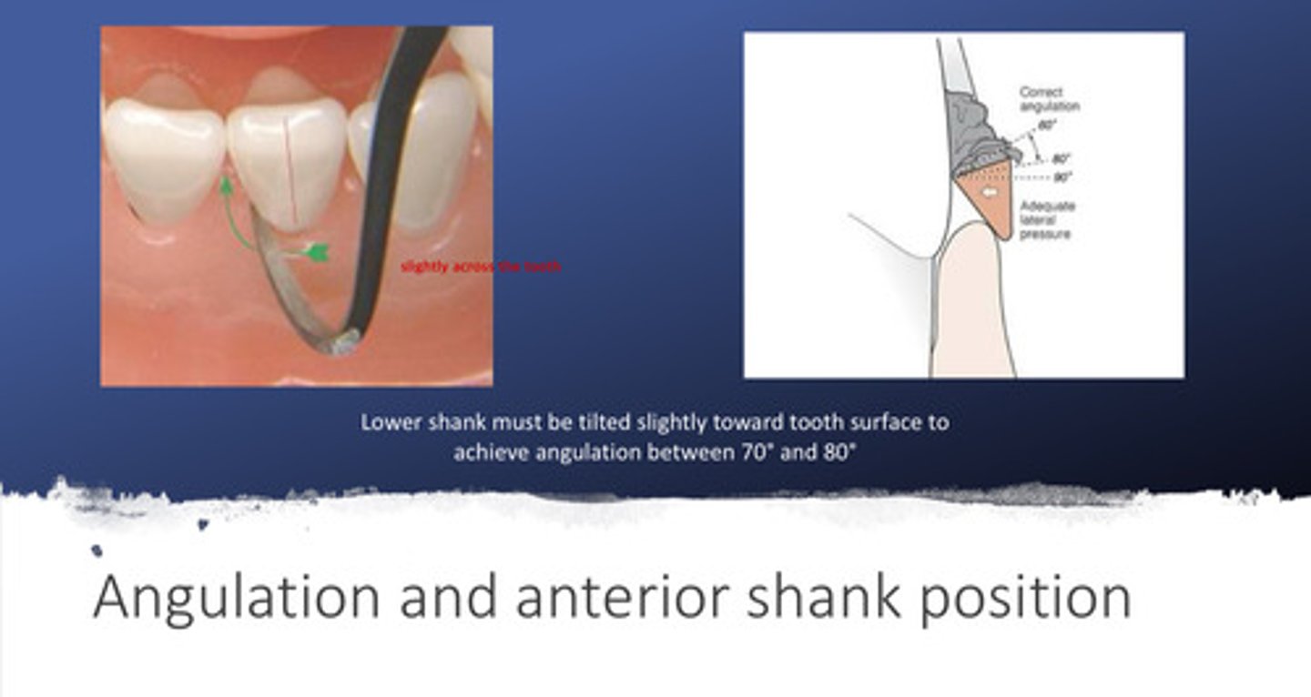 <p>the lower shank must be tilted slightly toward the tooth surface to achieve angulation between 70 and 80 degrees</p><p>- note that the lower shank looks like it slightly crosses the tooth rather than perfectly parallel</p>