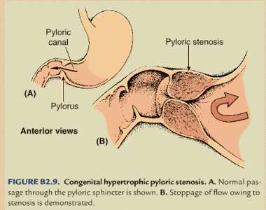 <p><span>Pyloric: </span><strong><span>nonbilious</span></strong><span> projectile vomiting; </span></p><ul><li><p><strong>Sphincter</strong> hypertrophy, polyhydraminos</p></li></ul><p><span>Duodenal: </span><strong><span>bilious</span></strong><span> vomiting, double bubble sign.</span></p><ul><li><p>Incomplete <strong>recanalization</strong>, “double bubble sign”, polyhydraminos</p></li></ul><p></p>