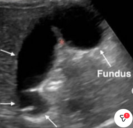 <p>Two normal variants of GB</p>