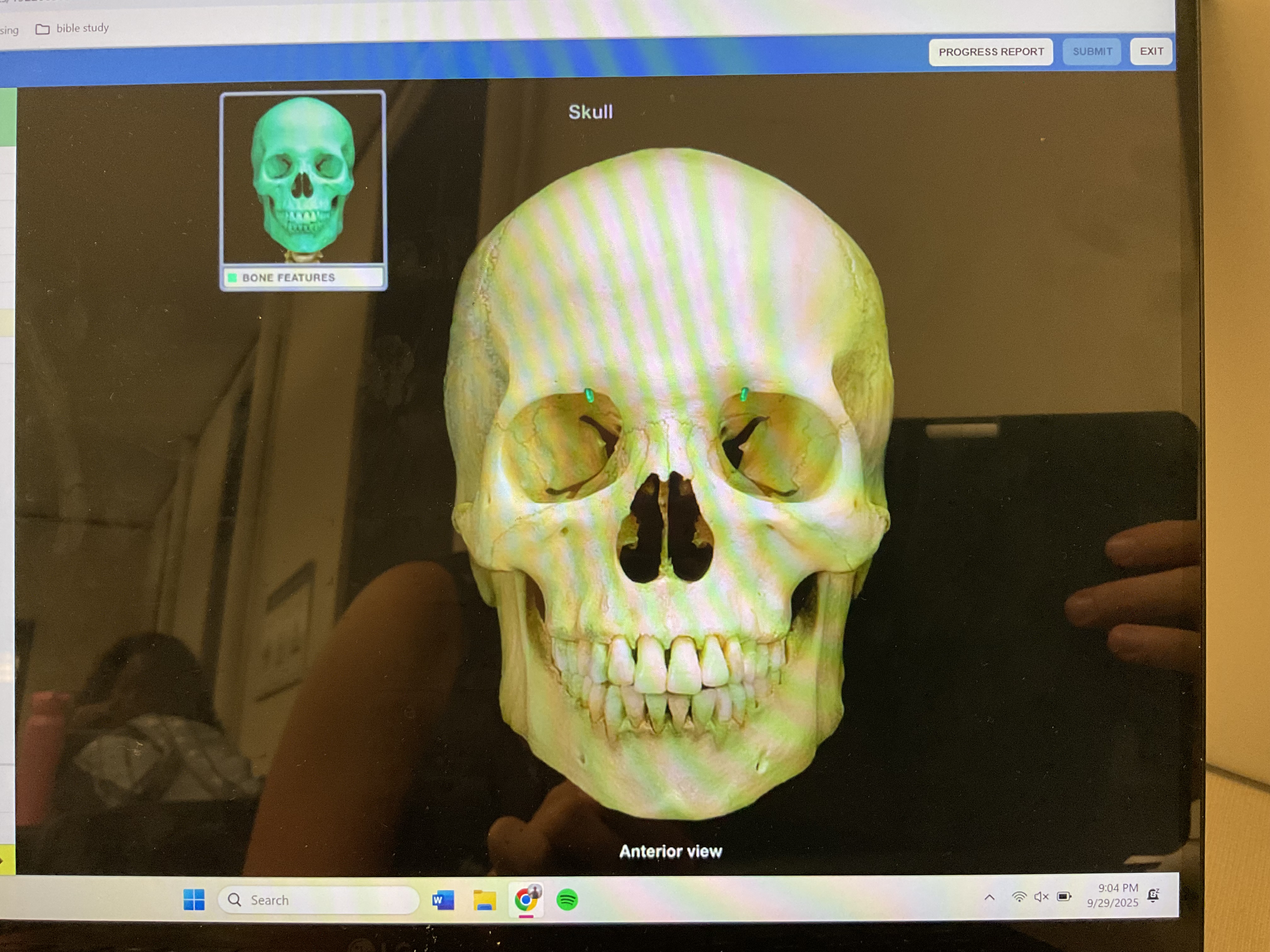 <p>Supraorbital notch (foramen)</p>