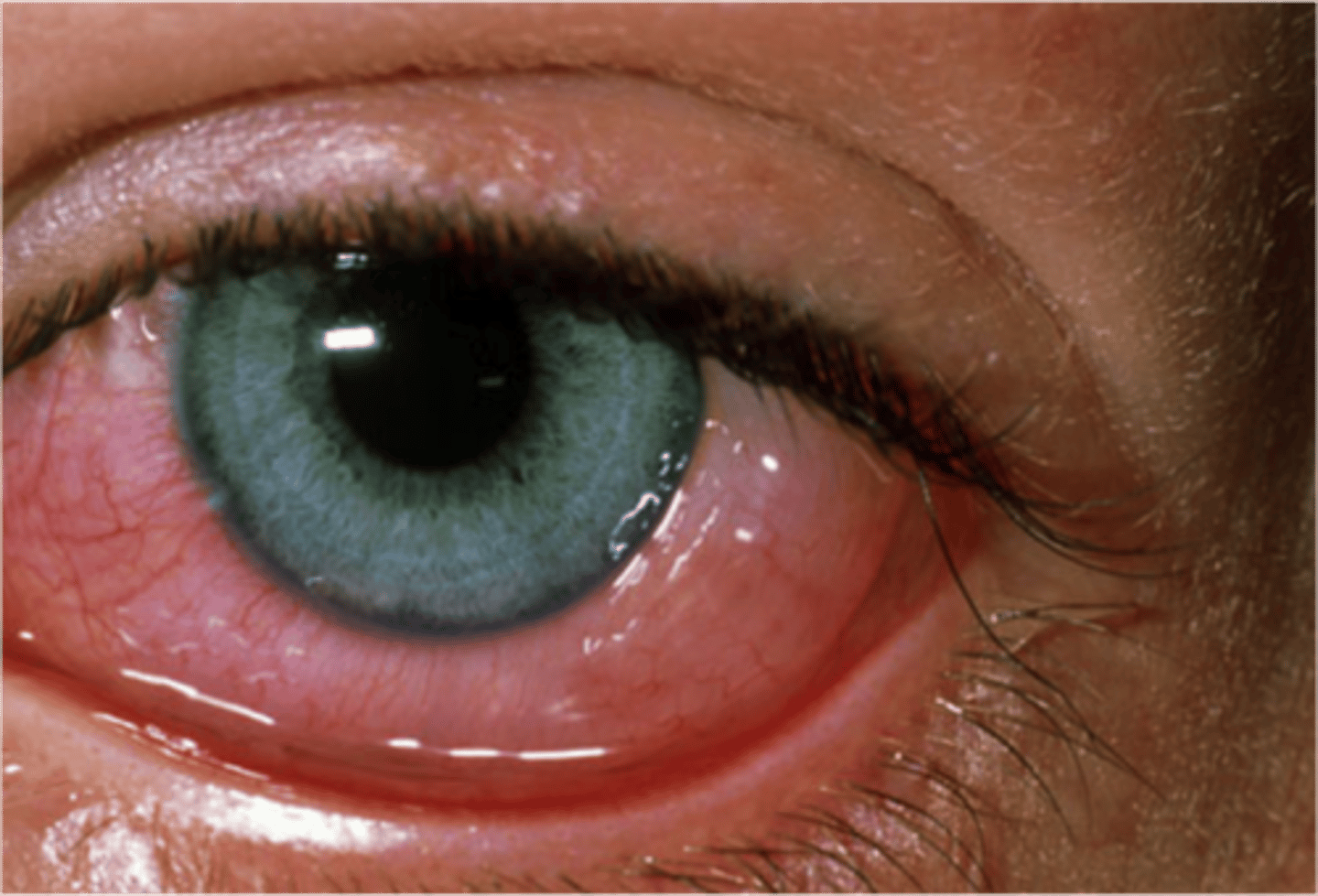 <p>inflammation of the conjunctiva</p>