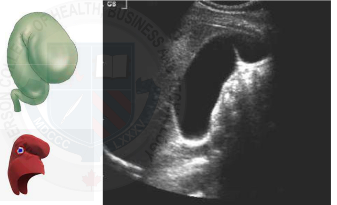 <p>Seen at a fold/kink in the fundus of the gallbladder </p><p>Common finding </p>