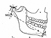 <ul><li><p>connects the midpoints of the two condyle heads.</p></li><li><p>During rotation, the most prominent point of the condyle head and the top of the chin move on a part of a sphere.</p></li></ul><p></p>