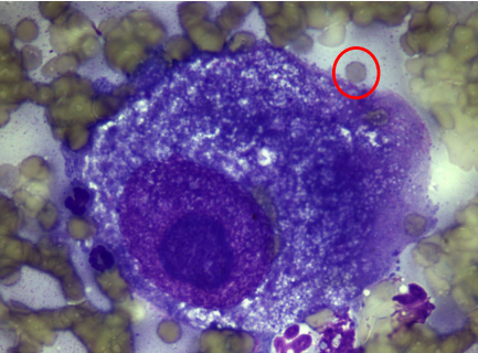 <p>Criteria of malignancy - Nucleoli</p><p>Describe the cell - malignant or no? Why?</p>