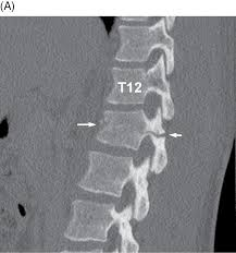 <p>Transverse fracture of lumbar vertebral body. Associated with severe visceral injuries</p>