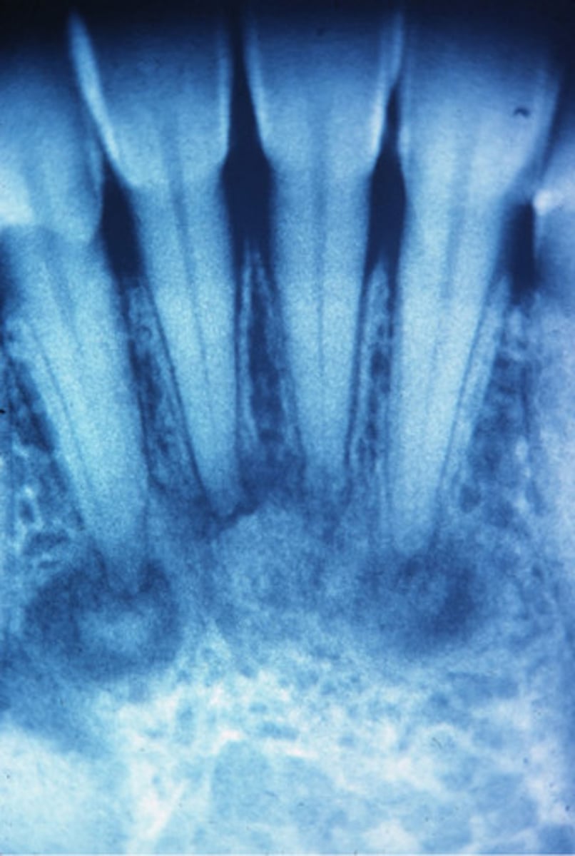 <p>localized change of normal cancellous bone with fibrous tissue and cementum-like material</p>