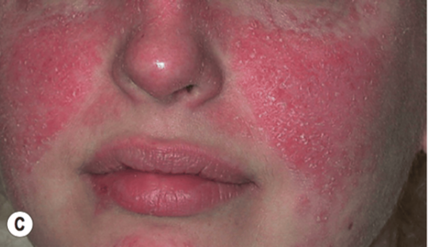 <p>diagnose this:</p><p>Malar rash --> Bright red, sharply defined, erythema with slight edema and scaling and spares nasolabial folds</p>