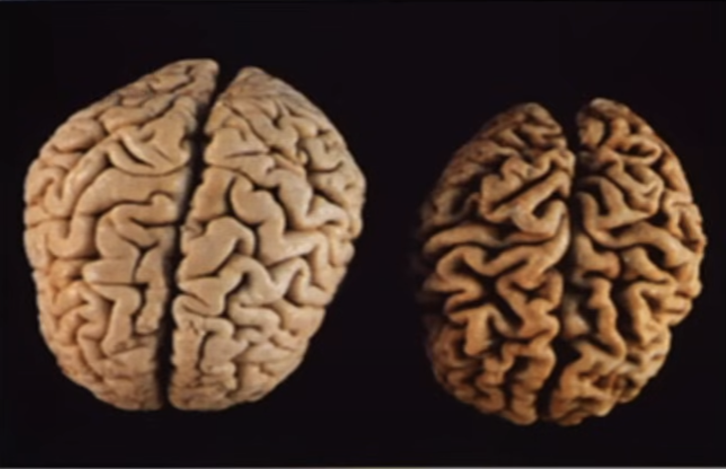 <p>What dementia related condition is shown in the photo?</p>