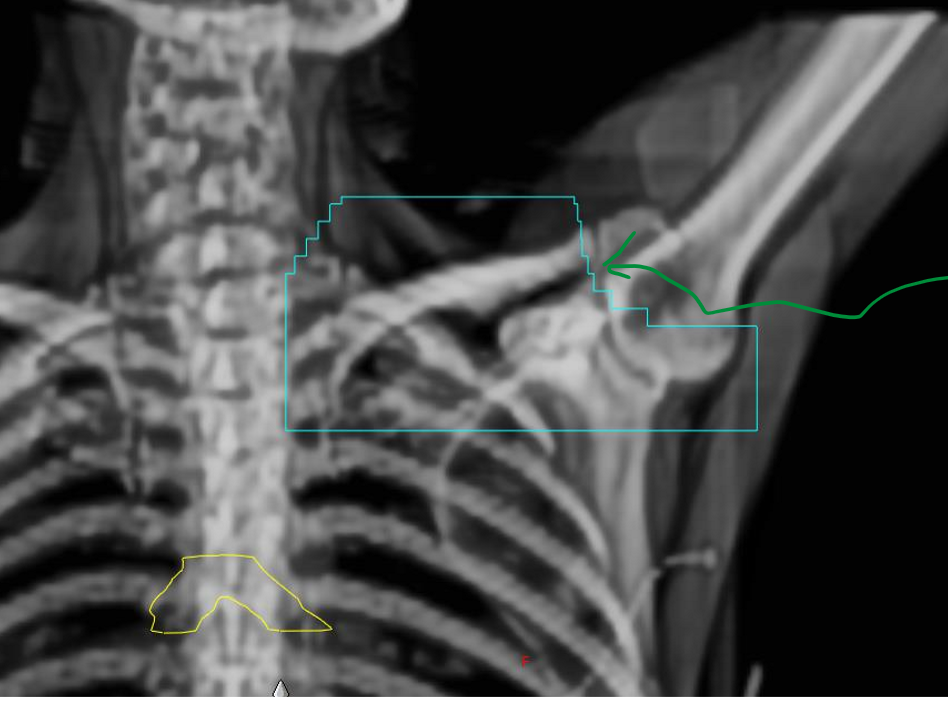 <p>what are the MLCs the arrow is pointing to shielding?</p><p>what two lymphatic nodes are being included in the BEV?</p>
