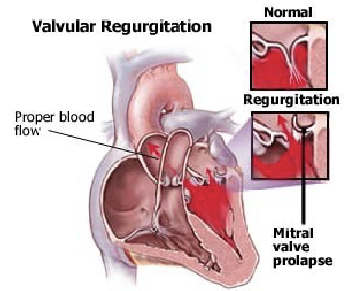 <p>Valvular Regurgitation</p>
