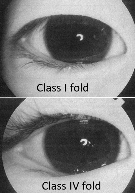<p>Eyelash condition that is congenital, relatively common, bilateral, and has no definitive cause.</p><ul><li><p>Common in Asian, Hispanic, and Native American populations</p></li></ul><p></p>