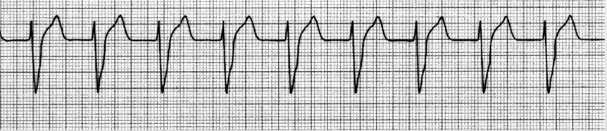 <p>regular, HR 40-100, wide QRS, no P waves</p>