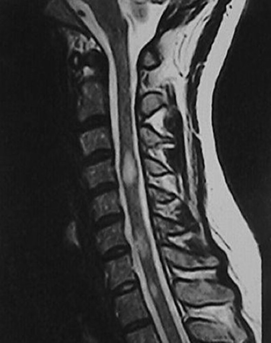 <p>MRI</p>