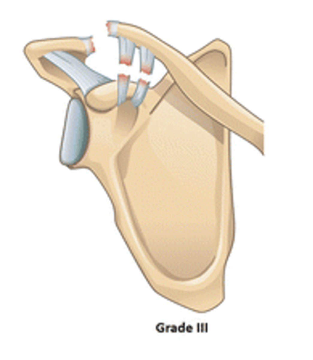 <p>According to the Rockwood Classification System, a grade III ACJ separation entails: __________</p>