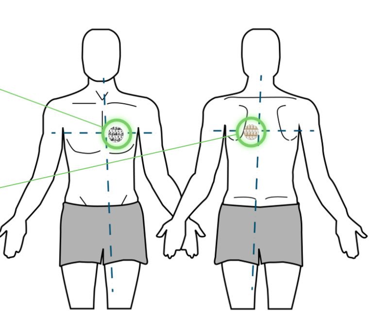 <p>Front: offset slightly to the left of the sternum, next to V2?</p><p>Back: Offset slightly to the left of the patient’s spine </p>