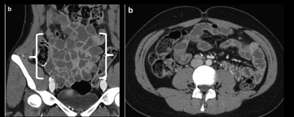 <p><span style="color: #872df4">CT Enterography</span> indications</p>