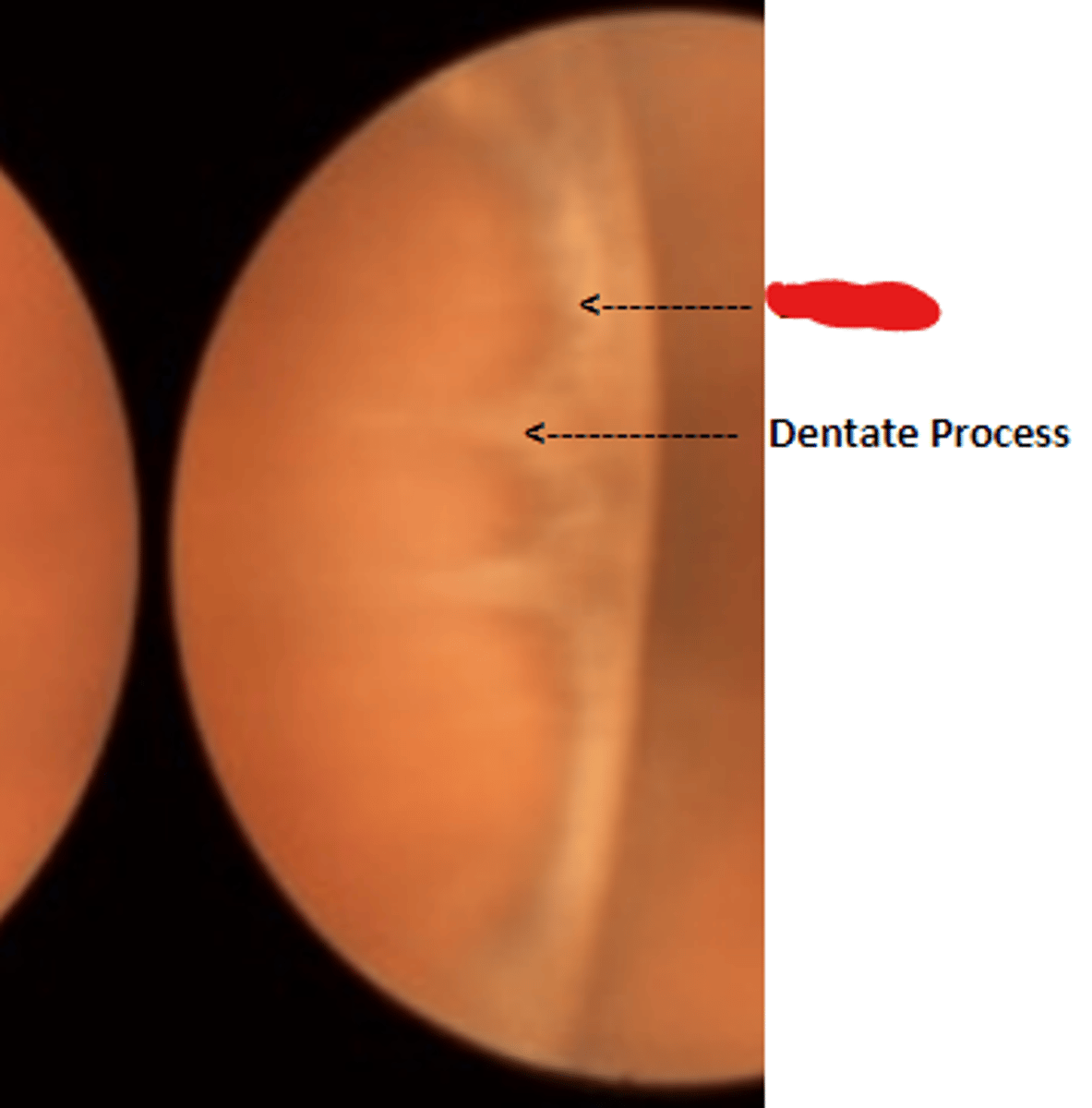 <p>round extensions of the ora serrata and pars plana. Is enclosed by two adjacent dentate processes.</p>