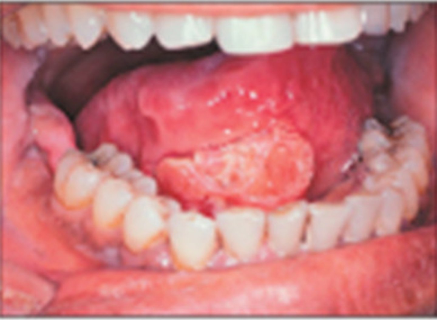 <p>irregular shaped white patch with rolled, indurated border </p><p>• high risk sites: 1) tongue - most common, 2) floor of mouth, 3) tonsillar pillar/soft palate, 4) lower lip</p><p>• population: males over 40</p><p>• NON-HEALING ulcer</p>