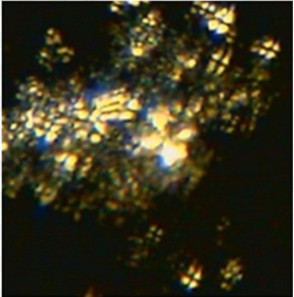 <p>Nephrotic sediments</p><ul><li><p>Lipiduria: Fatty casts + Maltese cross under polarized light</p></li></ul><p>Hematuria</p>