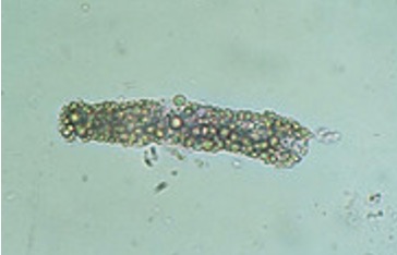 <p>what are fatty casts seen with?</p><p>what does it indicate?</p><p>how can we confirm?</p>