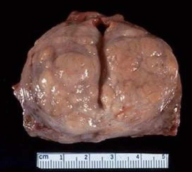 <p>Benign Prostatic Hyperplasia (BPH)</p>