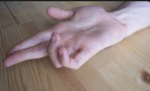 <p>weakness where medial fingers assume a resting posture of flexion in the PIP and DIP joints</p>