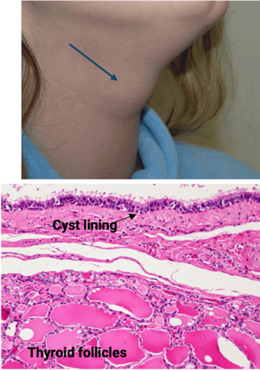 <p>Define Condition:</p><p>When portion of thyroglossal duct fails to involute</p><p>-Sx/PE:</p><p>&gt; Anterior Midline Neck Mass moving w/ swallowing or tongue protrusion</p><p>-Dx: (Histo)</p><p>&gt; Thyroid follicles in cyst/duct wall</p><p>&gt; Lining can either by Nonkeratinizing Squamous Cells (if near foramen cecum) OR Ciliated Epithelium (if in lower neck)</p>